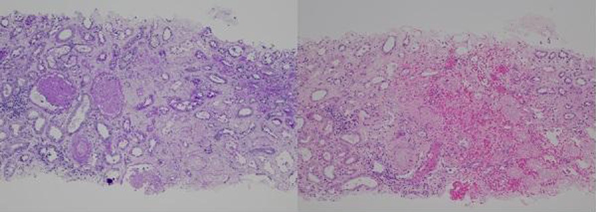 腎生検の弱拡大（左：PAS染色，右：HE染色）